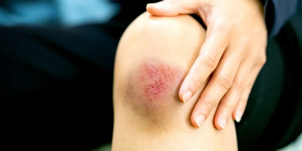 What Does It Mean When You Dream of Bruise