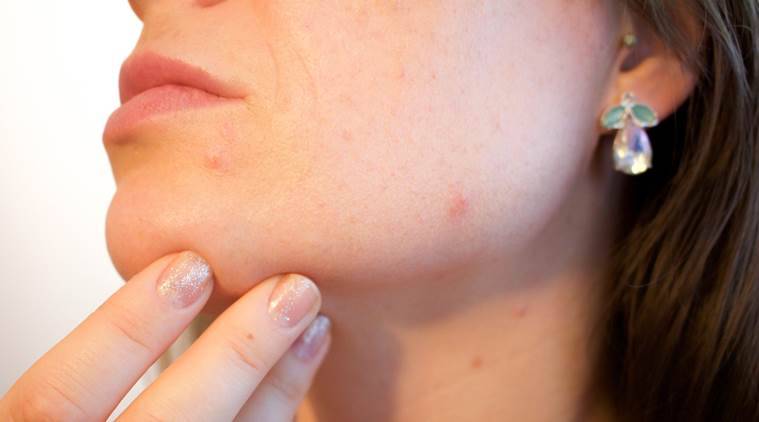 What does it mean to dream about acne?