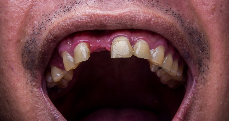 What does it mean to dream about teeth falling out?